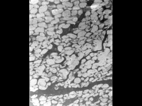 Микроскопическое картина липомы