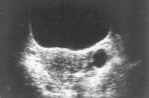 Эхограмма органов малого таза в поперечной плоскости, слева от матки определяется 'киста' с тонкими стенками