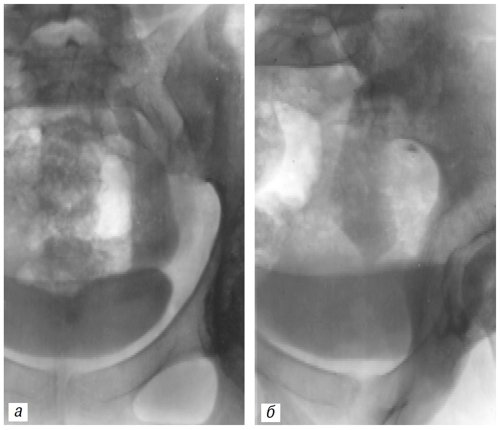 Рентгенограммы дистальной части левого мочеточника в прямой (а) и косой (б) проекциях, отчетливо определяется уретероэктазия и стеноз дистальной части