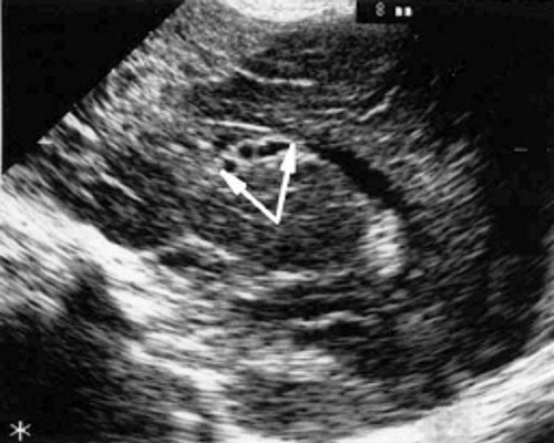 Эхоэнцефалограмма ребенка со смешанной герпес-цитомегаловирусной инфекцией. Левое полушарие