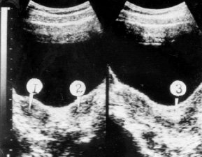 Удвоение матки и влагалища, частичная аплазия одного влагалища, состояние после опорожнения гематокольпоса: 1, 2 - две матки; 3 - опорожненное влагалище