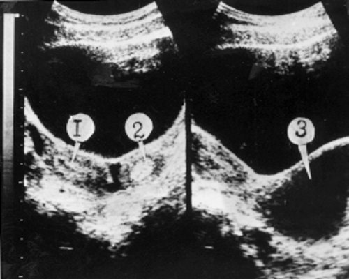 Удвоение матки и влагалища, частичная аплазия одного влагалища до опорожнения гематокольпоса в замкнутом влагалище: 1, 2 - две матки; 3 - замкнутое влагалище