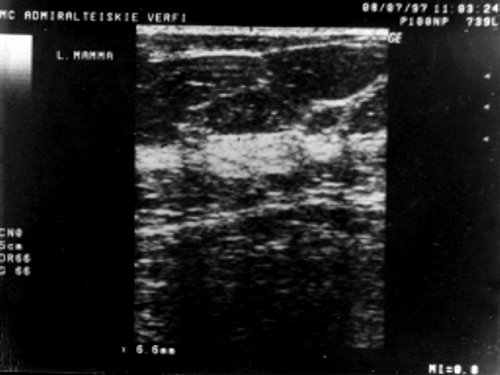 УЗИ: молочная железа, постменопаузальный тип