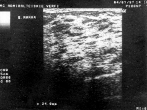 УЗИ: диффузная мастопатия, смешанный тип