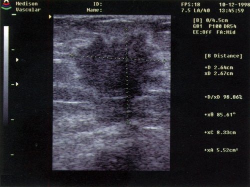 Эхограмма злокачественной опухоли молочной железы (б)