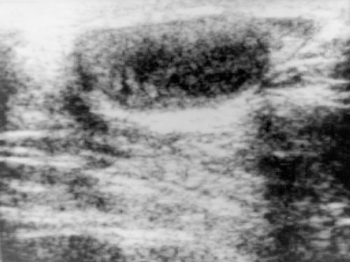 Поражение яичка при тестикулярном рецидиве острого лимфобластного лейкоза у ребенка, паренхима неоднородная