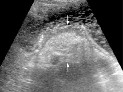 УЗИ: эндофитный рак задней стенки тела желудка