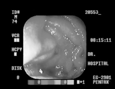 Эндоскопическая картина аденокарциномы тощей кишки
