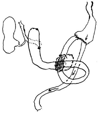 Схема расположения воспалительного инфильтрата, вызвавшего сдавление 12-перстной кишки