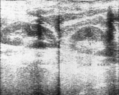 Эхограмма почек больной, страдающей множественной миеломой 5 лет (1 - почки левая и правая)