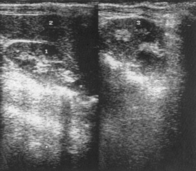 Эхограмма почек с множественной миеломой (1 - правая почка, 2 - печень, 3 - левая почка)