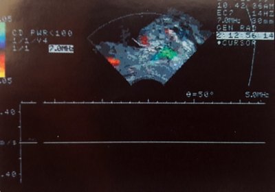 Фрагмент видеозаписи допплерографической оценки потока мочи в простатическом отделе уретры с применением ректального датчика