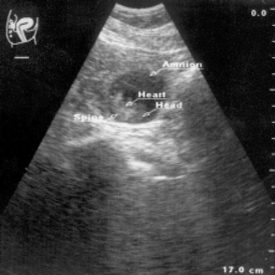 УЗИ - трубная беременность