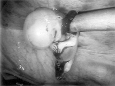 Лапароскопия - трубная беременность