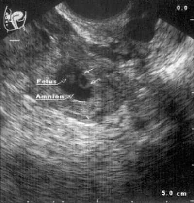 Прогрессирующая левосторонняя трубная беременность сроком 5 нед - трансвагинальное поперечное сканирование