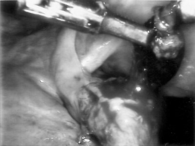 Лапароскопическая картина - прогрессирующая левосторонняя трубная беременность сроком 5 нед (при сальпинготомии и удалении плодного яйца)