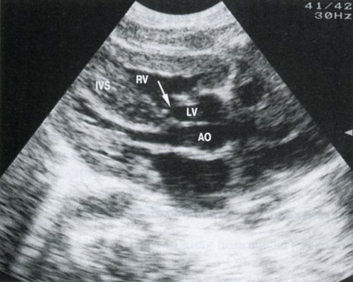УЗ-сканирование сердца по длинной оси у новорожденного (2 сут жизни)