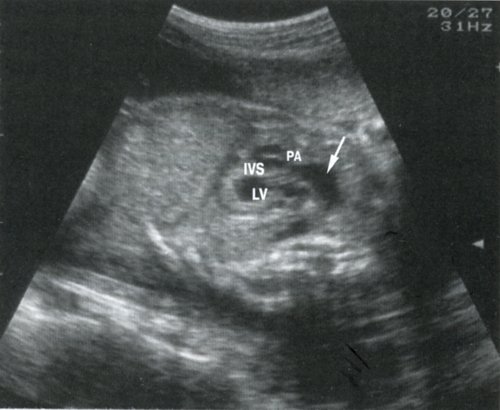 УЗИ сердца у плода в 28 недель беременности - выраженная гипертрофия миокарда и увеличение размеров левого желудочка (LV) и межжелудочковой перегородки (IVS), имеется сужение легочной артерии (PA) на уровне клапанного кольца и аневризматическое расширение ствола (стрелка), указывающее на выраженность клапанного стеноза