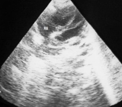 Эхокардиограмма грудного ребенка перед выпиской из стационара - нормальные размеры правого предсердия (RA)