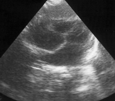 Нормальная эхокардиограмма грудного ребенка через год после лечения (субкостальный доступ)