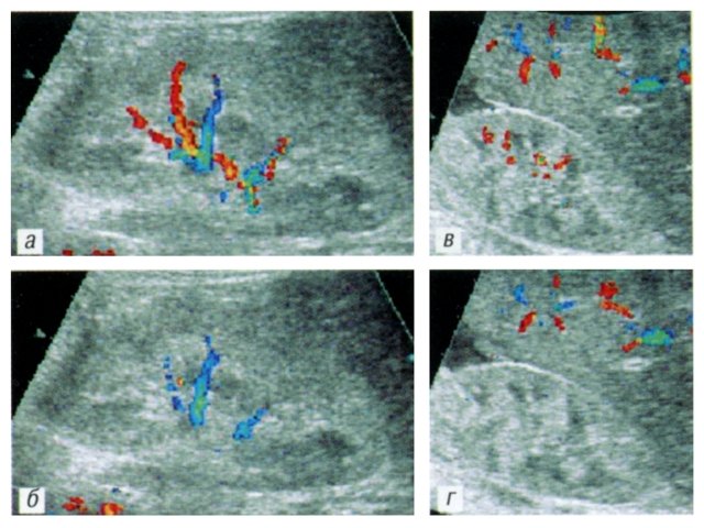 Диффузное обеднение интраренального сосудистого рисунка при гемолитико-уремическом синдроме у детей
