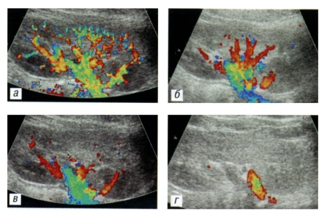 Эхограммы интраренального сосудистого рисунка условно здорового ребенка 8 лет - продольное сканирование со спины (значение фильтра: а - 0,1 м/с; б - 0,2 м/с; в - 0,3 м/с; г - 0,6 м/с)