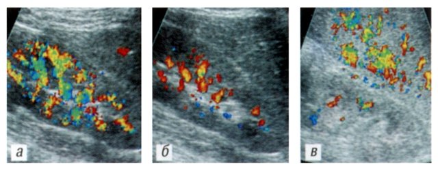Сравнение интенсивности сосудистого рисунка в почке и соседнем фрагменте правой доли печени - латеральное продольное сканирование
