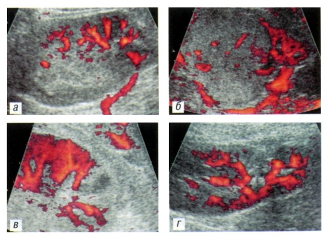 Локальное обеднение интраренального сосудистого рисунка - дуплексное допплеровское сканирование в режиме энергетического допплера