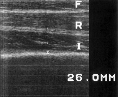 УЗ-эхограмма мышц бедра в норме (продольное сканирование, F - подкожно-жировой слой, R - m. rectus femoris, I - m. vastus)
