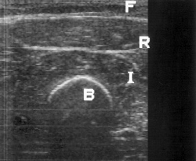 УЗ-эхограмма мышц бедра в норме (поперечное сканирование, F - подкожно-жировой слой, R - m. rectus femoris, I - m. vastus)