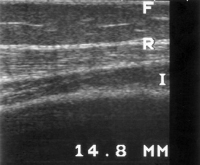 УЗ-эхограмма мышц бедра у пациента с хроническим гломерулонефритом (продольное сканирование, F - подкожно-жировой слой, R - m. rectus femoris, I - m. vastus intermedius, B - кость)