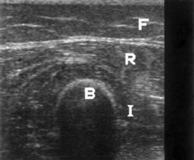 УЗ-эхограмма мышц бедра у пациента с хроническим гломерулонефритом (поперечное сканирование, F - подкожно-жировой слой, R - m. rectus femoris, I - m. vastus intermedius, B - кость)