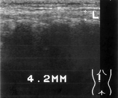 УЗ-эхограмма длиннейших мышц спины у пациента с хроническим гломерулонефритом