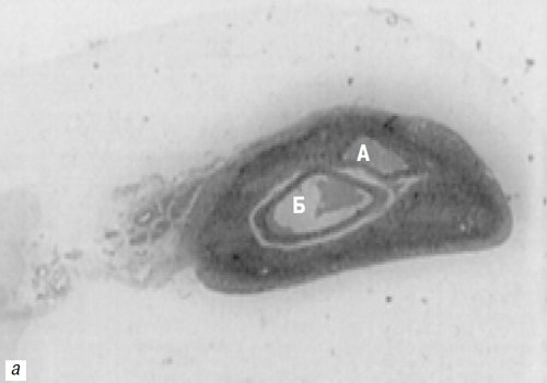 Гистологическая картина: яичник девочки, 14 лет, с атретическими (А) и растущими (Б) фолликулами