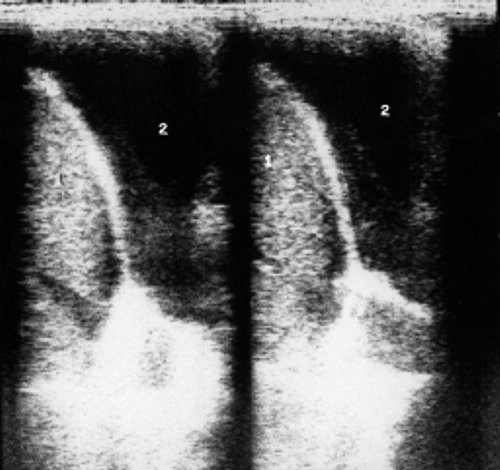 Сонографическое изображение жидкости в левой плевральной полости у больного неходжкинскими злокачественными лимфомами