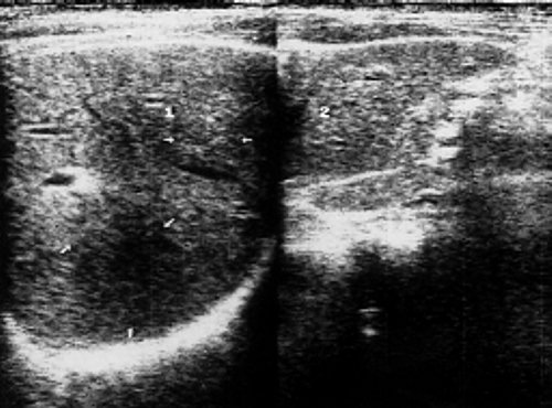 Сонограмма печени больного неходжкинскими злокачественными лимфомами