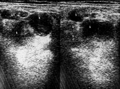 Сонограмма печени больного неходжкинскими злокачественными лимфомами с наличием множественных очагов в паренхиме