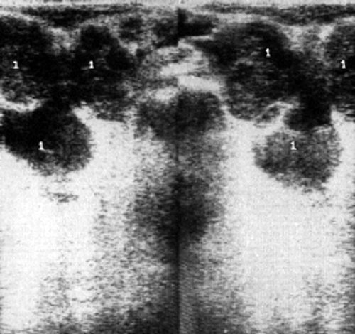 Сонограмма крупного конгломерата из лимфатических узлов