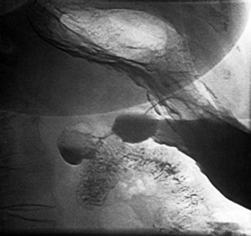 Рентгенограмма дивертикула петли двенадцатиперстной кишки