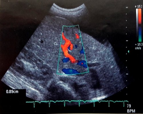 Эхограмма: печеночная артерия (режим энергетического допплера)