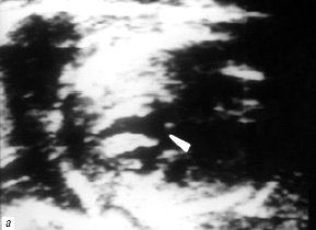 В-сканирование сердца плода на 20-й неделе гестации - проекция 5-камер сердца, тетрада Фалло (стрелкой обозначен подаортальный дефект мезжелудочковой перегородки)