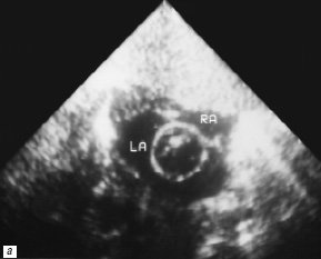 Процедура атриосептостомии (2-е сутки жизни) - эхокардиограмма (RA - правое предсердие, LA - левое предсердие)