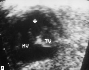 В-сканирование сердца плода на 26-й неделе гестации - проекция 4 камер сердца, стрелкой обозначено отсутствие межжелудочковой перегородки (MV - митральный клапан, TV - трикуспидальный клапан)