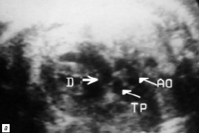 В-сканирование сердца плода на 23-й неделе гестации - проекция выводного отдела правого желудочка, отхождение аорты и легочной артерии от правого желудочка