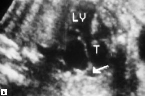 В-сканирование сердца плода на 25-й неделе гестации: проекция 5 камер сердца (LV - левый желудочек, T - трункус), стрелкой обозначено отхождение устья легочной артерии от боковой поверхности трункуса