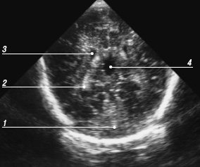 Эхограмма мозга - четвертый корональный срез через тела боковых желудочков