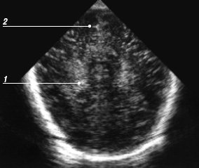 Эхограмма мозга - шестой корональный срез через затылочные доли над боковыми желудочками