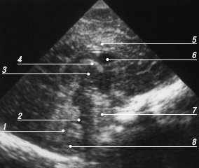 Эхограмма мозга - срединный сагиттальный срез (1 - мозжечок, 2 - IV желудочек, 3 - III желудочек, 4 - свод и сосудистое сплетение в отверстиях Монро и крыше III желудочка, 5 - мозолистое тело, 6 - полость прозрачной пергородки, 7 - ножки мозга, 8 - большая цистерна