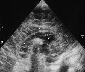Эхограмма мозга - срединный сагиттальный срез (9 - полость Верге, 10 - мозолистое тело, 11 - полость прозрачной перегородки, 12 - III желудочек)