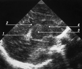 Эхограмма мозга - парасагиттальный срез через каудо-таламическую выемку